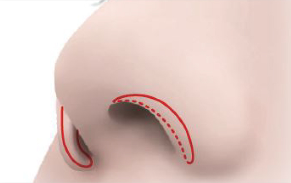 切開のデザインを決定します