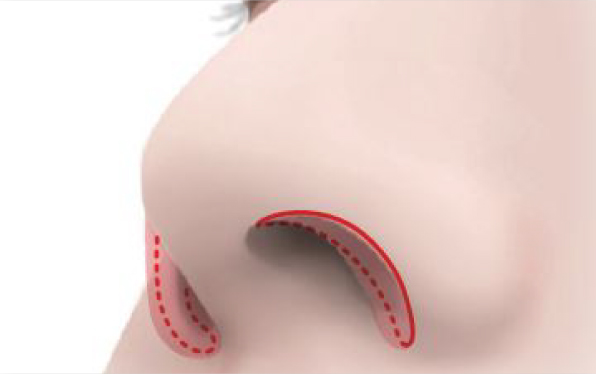 鼻孔縁を切除します