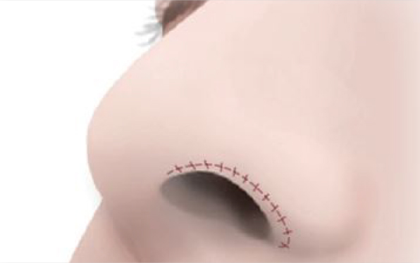 縫合して完了です