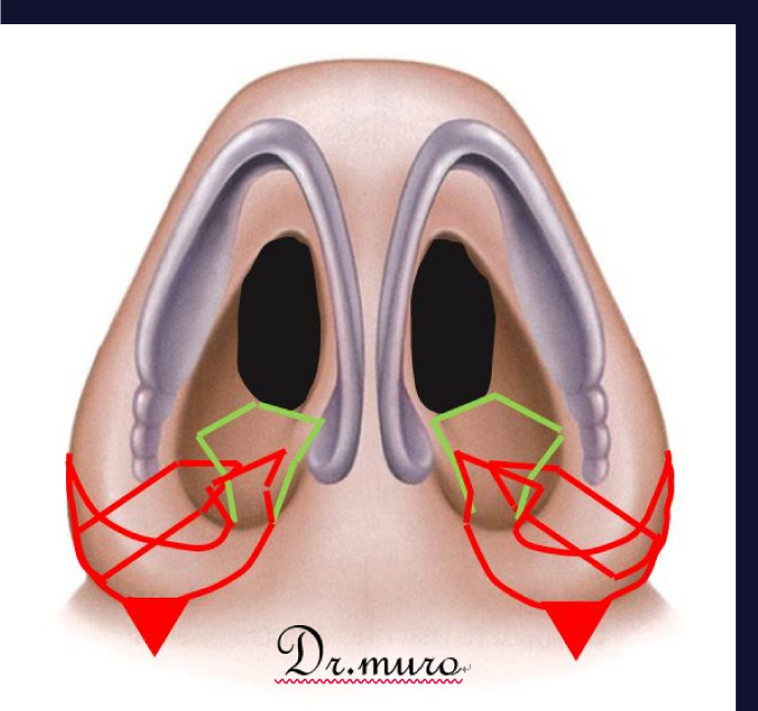 凹みやゆがみなど仕上がりのデメリットを解消!<br>より自然で目立たない鼻に