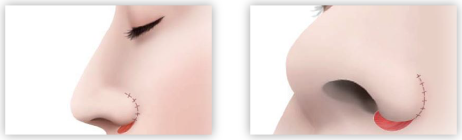 上から順に縫合していきます