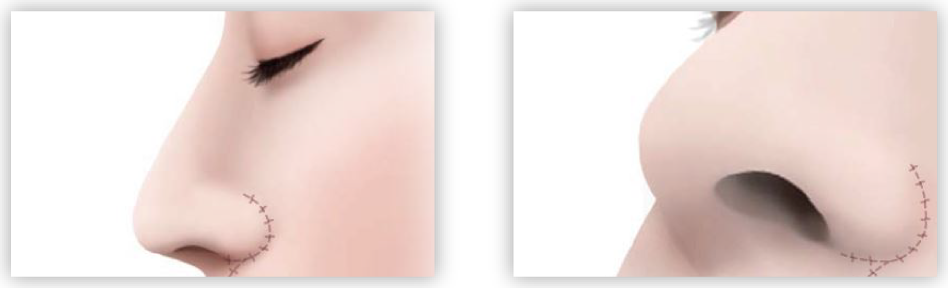 小鼻の下も縫合して完了です