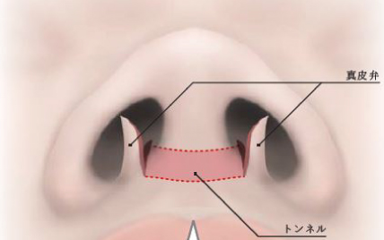 真皮弁、皮膚下のトンネルを作成します