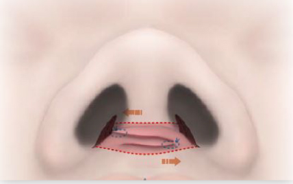 皮膚下のトンネルの中で真皮弁を交差させて縫い合わせます