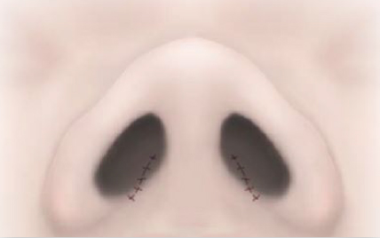 縫合して手術は完了です