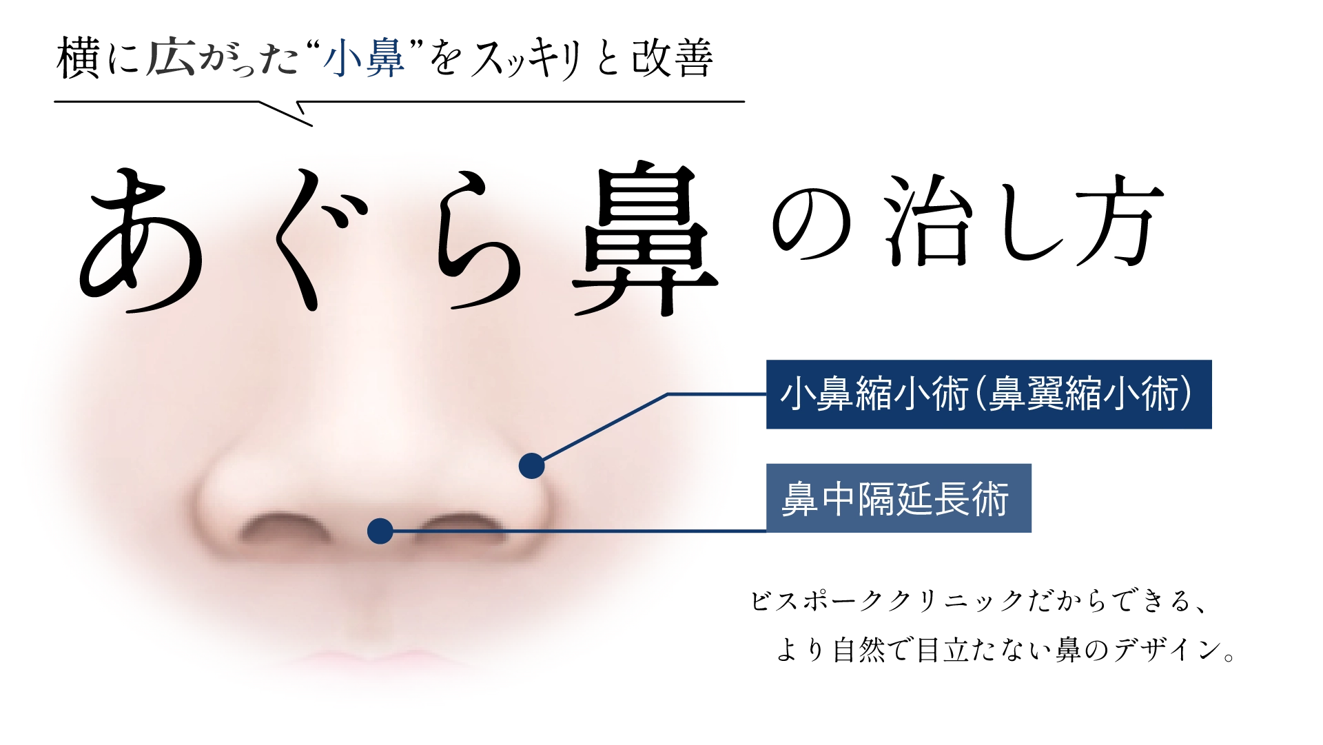 あぐら鼻の治し方 ビスポーククリニックだからできる、より自然で目立たない鼻のデザイン。